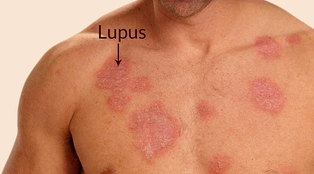Sistemik Lupus Erİtematozus (SLE)