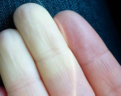 Raynaud Hastalığı nedir?