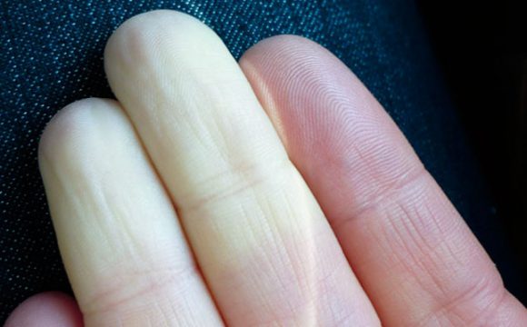 Raynaud Hastalığı nedir?